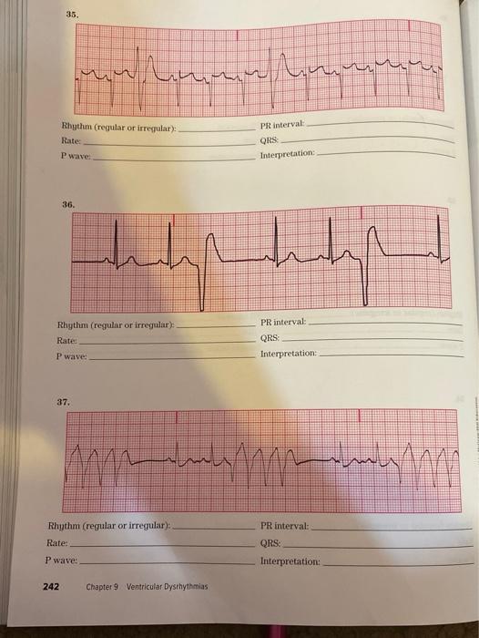 32 Southm Regular Or Irregular Wave Perval Qis Boerpectation Rhythm Regular Or Irregular Fate Pr Interval Pwave Qrs 2