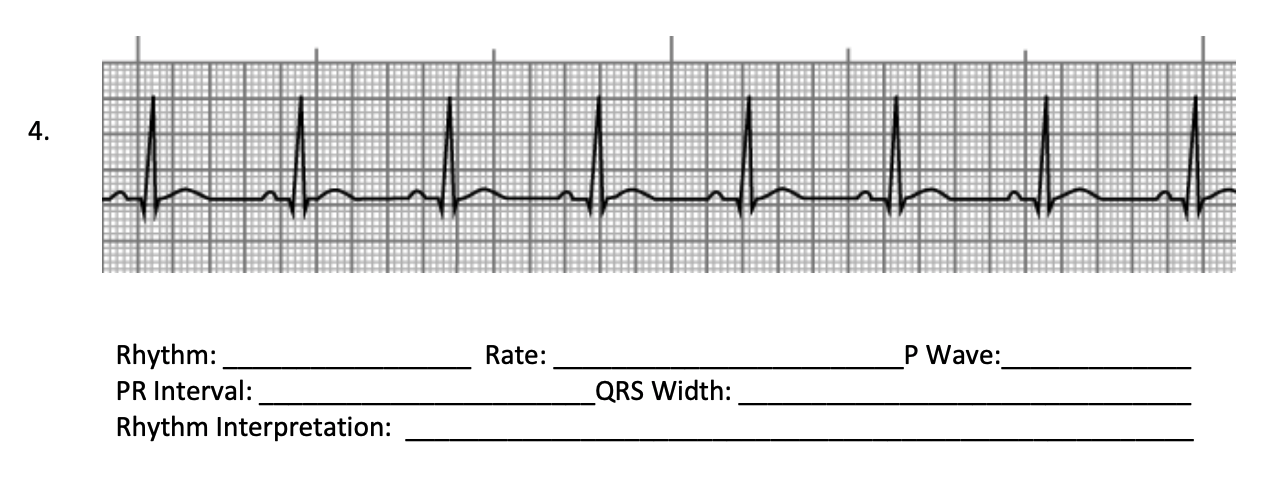 4 Ul Rate P Wave Rhythm Pr Interval Rhythm Interpretation Qrs Width 1