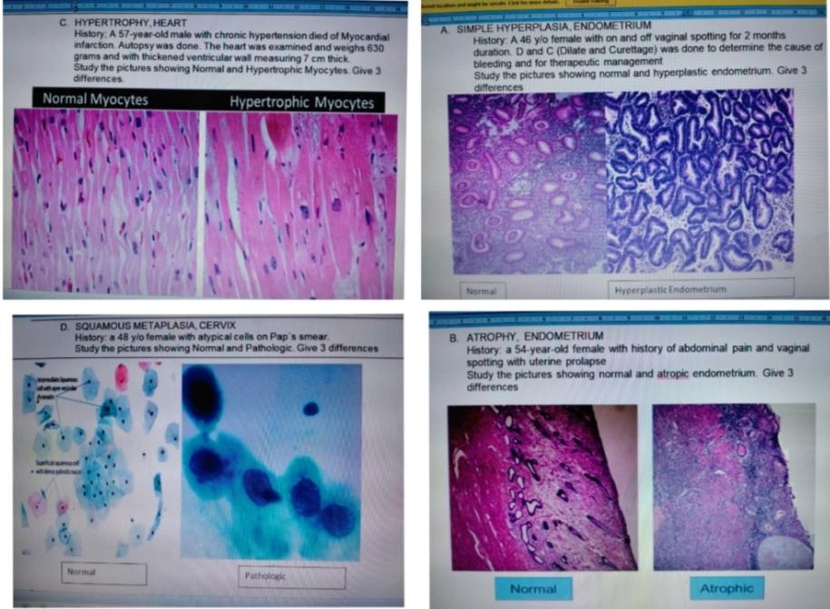 C Hypertrophy Heart History A 57 Year Old Male With Chronic Hypertension Died Of Myocardial Infarction Autopsy Was Do 1