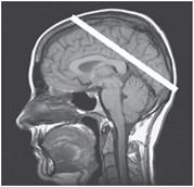 Mri And Basic Imaging Sequences 5 9 The Operator Wishes To Acquire An Oblique Slice Shown By The Orientation Of The Whi 1