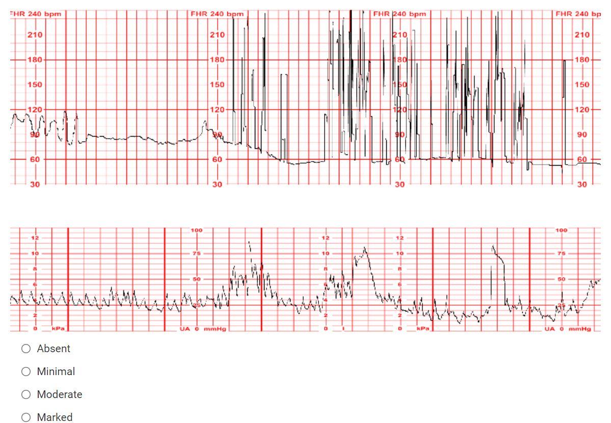 In The Efm Strip Below What Is The Fhr Baseline Variability 1