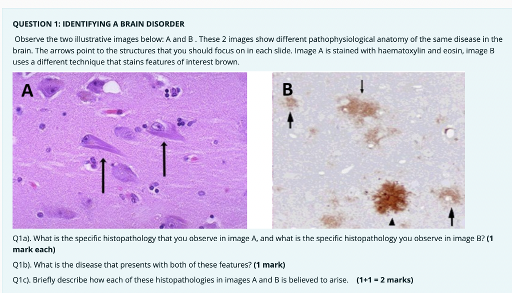 Question 1 Identifying A Brain Disorder Observe The Two Illustrative Images Below A And B These 2 Images Show Differe 1