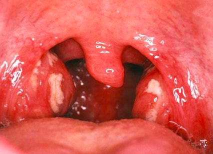 A Patient Complained He Had A Fever Of 39 And Sore Throat For 2 Days The Number Of The White Blood Cells Is Higher Tha 1