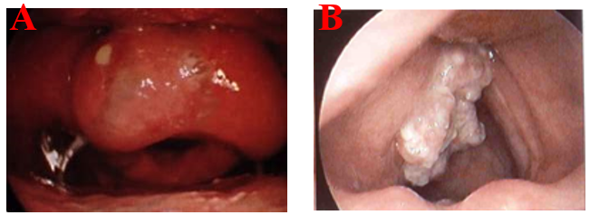 Following Pictures Are From Two Patients Which One Of Them Might Has The Laryngeal Obstruction A Or B And What S The 1