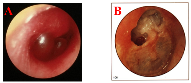 Following Pictures Are From Two Patients Which One Of Them Is Acute Otitis Media A Or B 1