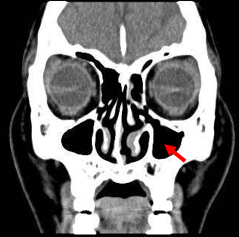 Which Sinus Is The One Indicated By The Red Arrow In The Following Picture 1