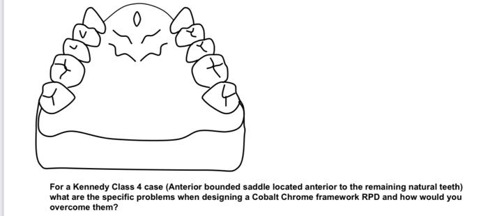O 2002 For A Kennedy Class 4 Case Anterior Bounded Saddle Located Anterior To The Remaining Natural Teeth What Are The 1