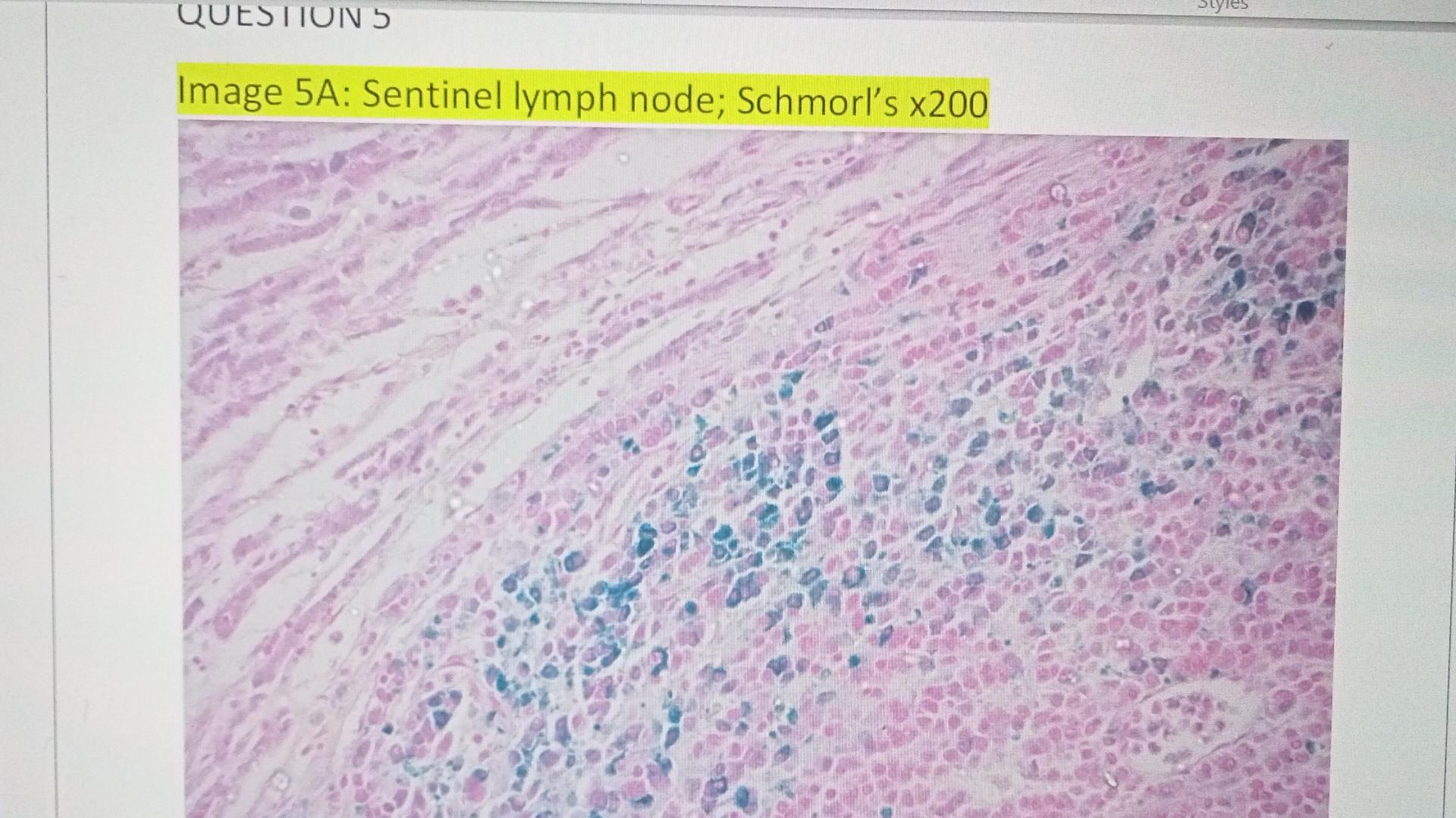 Question 5 Syles Image 5a Sentinel Lymph Node Schmorl S X200 1