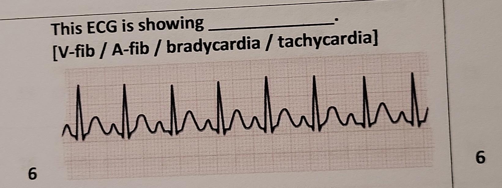 6 This Ecg Is Showing V Fib A Fib Bradycardia Tachycardia Hihihihihihit 6 1