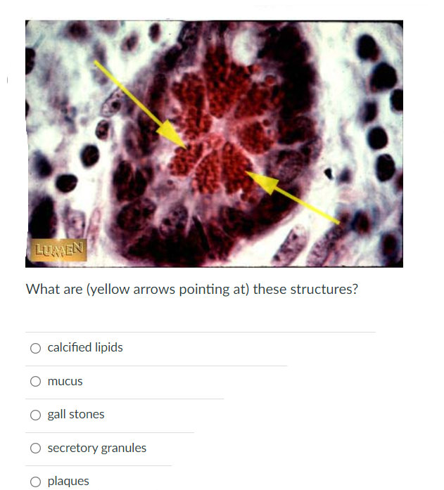 Lumen What Are Yellow Arrows Pointing At These Structures Calcified Lipids Mucus O Gall Stones Secretory Granules O P 1