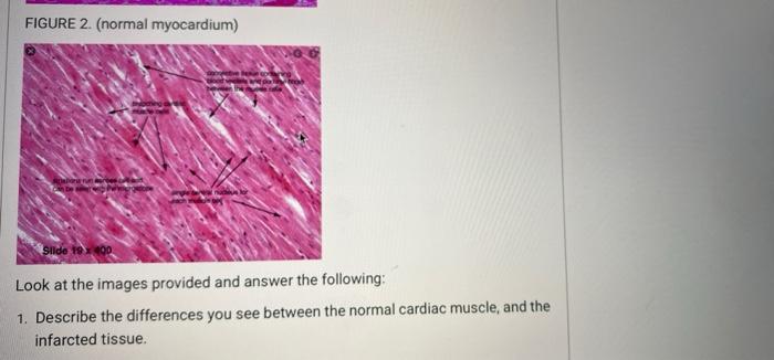 Myocardial Infarction Myocardial Infarction Mi Is Considered One Of The Leading Causes Of Mortality In Humans Histolo 2
