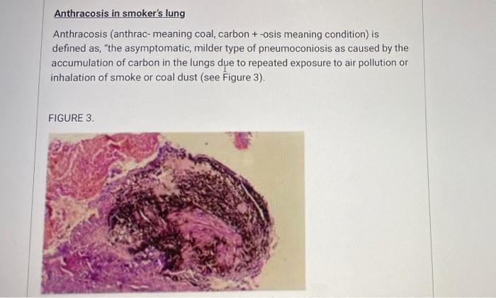 Anthracosis In Smoker S Lung Anthracosis Anthrac Meaning Coal Carbon Osis Meaning Condition Is Defined As The A 1