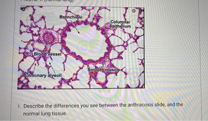 Anthracosis In Smoker S Lung Anthracosis Anthrac Meaning Coal Carbon Osis Meaning Condition Is Defined As The A 2