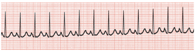 1 A Patient Arrives For A Routine Physical And You Are Asked To Perform An Ecg The Rhythm On The Monitor Is I What 1