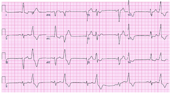1 A Patient Arrives For A Routine Physical And You Are Asked To Perform An Ecg The Rhythm On The Monitor Is I What 2
