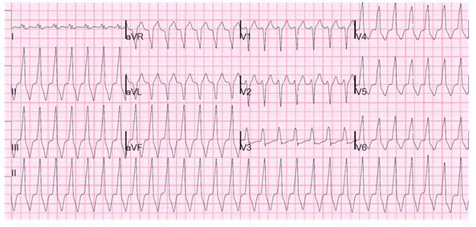 1 A Patient Arrives For A Routine Physical And You Are Asked To Perform An Ecg The Rhythm On The Monitor Is I What 3