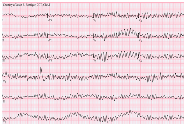 Question 1 Indentify The Ecg In The Following I A Venticular Fibrillation B Atrial Fibrillation C Ventricular Ta 1