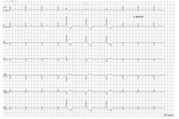 Question 1 Indentify The Ecg In The Following I A Venticular Fibrillation B Atrial Fibrillation C Ventricular Ta 2
