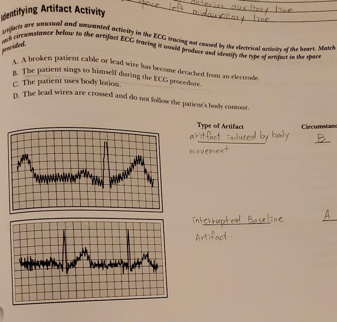 Prisk Auxiliary Line Identifying Artifact Activity Left Midauxiliary Line Are Artifacts Provided Unusual And Unwanted A 1