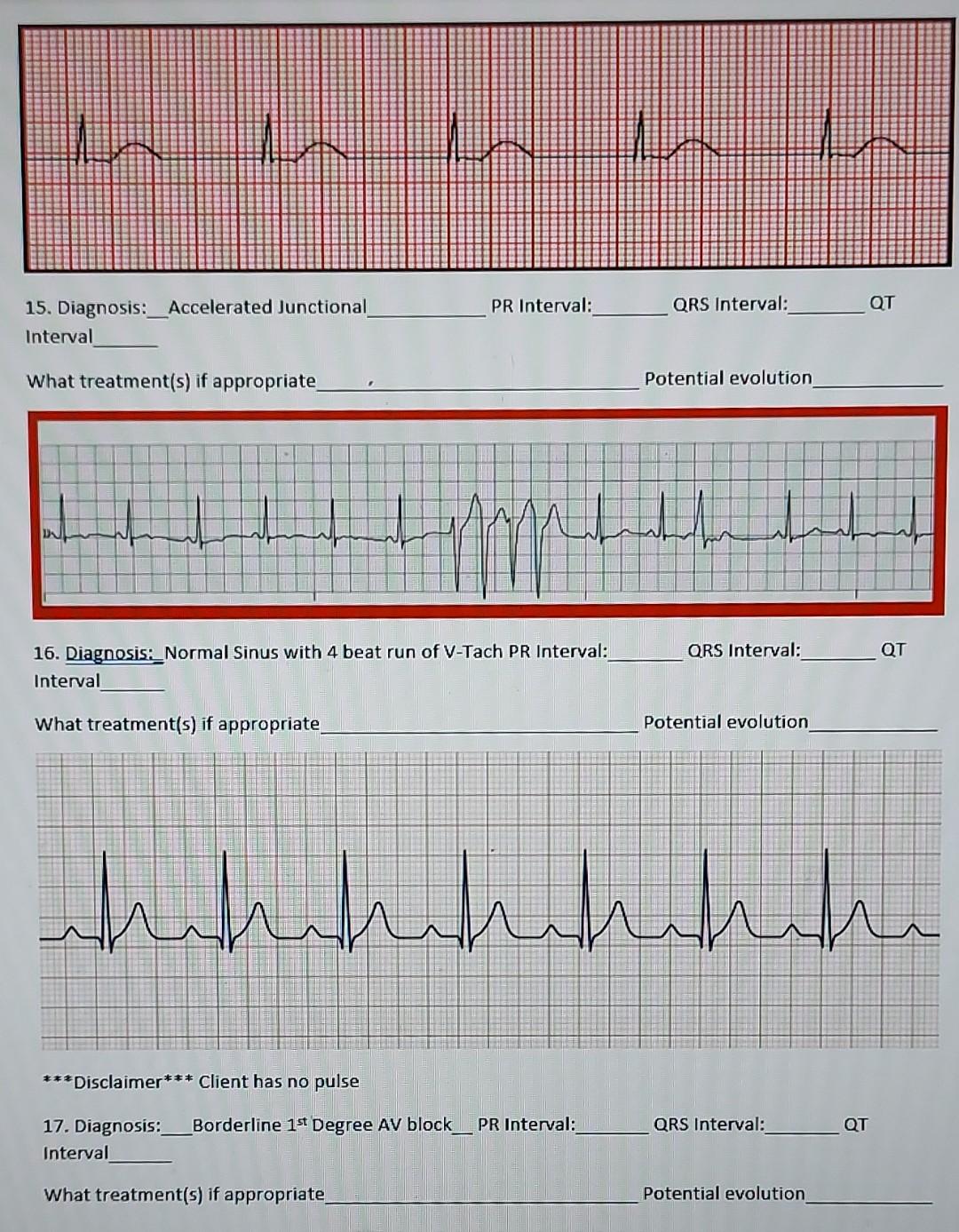 Pr Interval Qrs Interval Qt 15 Diagnosis Accelerated Junctional Interval What Treatment S If Appropriate Potential 1