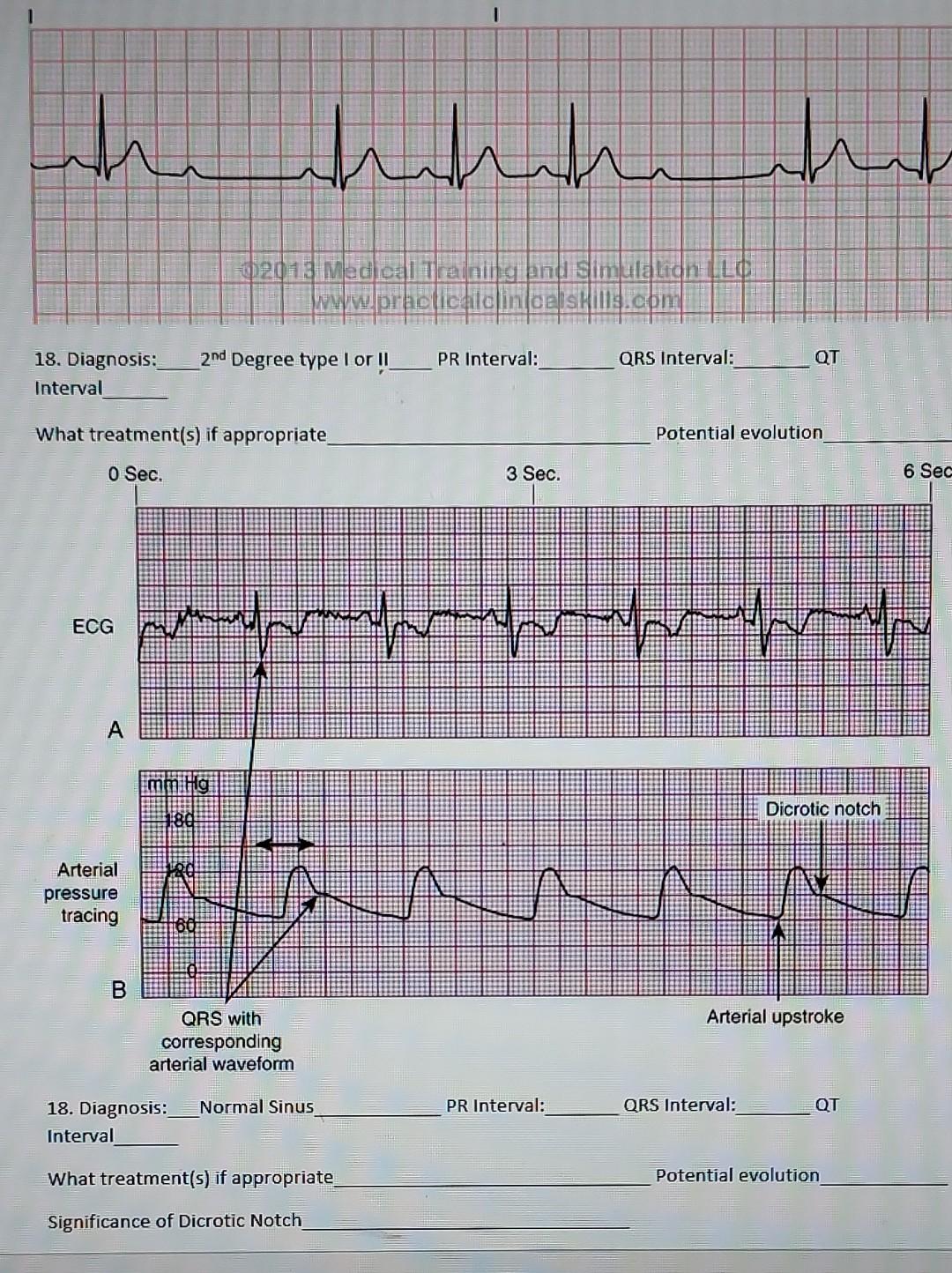 Wh Whehehe While 2013 Medical Training And Simulalion Llo Www Practicale Ame Com 2nd Degree Type I Or Ii Pr Interval Q 1