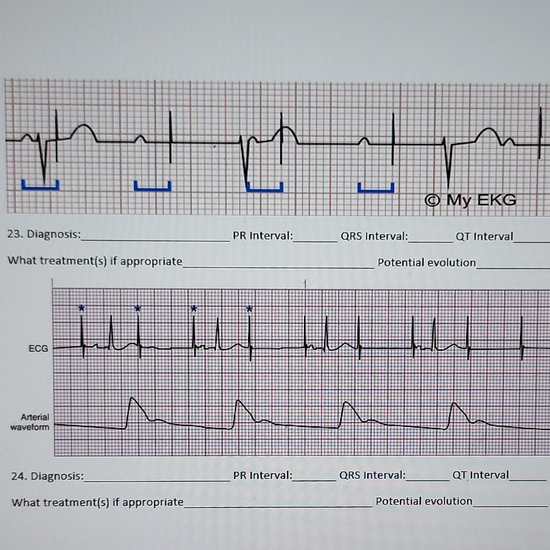 You My Ekg 23 Diagnosis Pr Interval Qrs Interval Qt Interval What Treatment S If Appropriate Potential Evolution 1