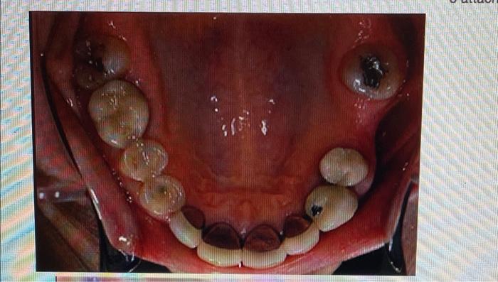 A Patient Came To You With A Complaint Of Pain In 36 And 37 Area The Patient Said That The Pain Started 5 Days Ago And 1