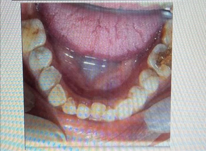 A Patient Came To You With A Complaint Of Pain In 36 And 37 Area The Patient Said That The Pain Started 5 Days Ago And 2