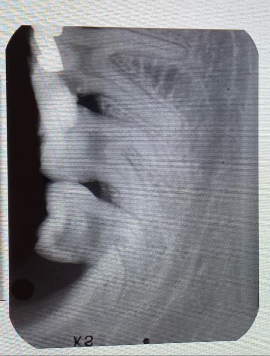 A Patient Came To You With A Complaint Of Pain In 36 And 37 Area The Patient Said That The Pain Started 5 Days Ago And 3