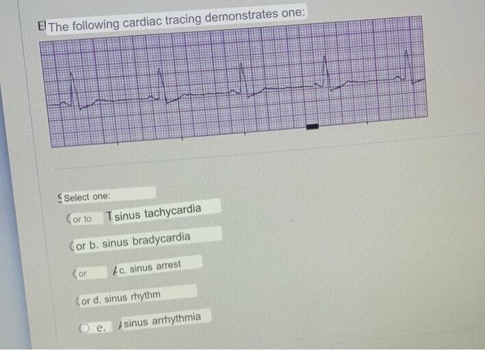 E The Following Cardiac Tracing Demonstrates One Select One Or To Tsinus Tachycardia Or B Sinus Bradycardia Or C Sin 1