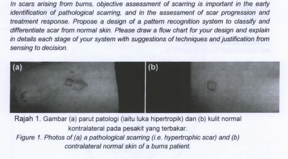 In Scars Arising From Burns Objective Assessment Of Scarring Is Important In The Early Identification Of Pathological S 1