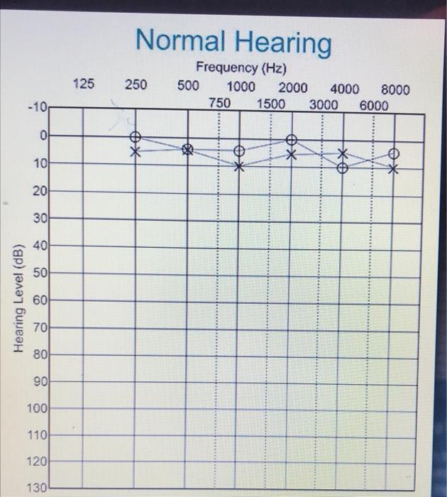 The Pure Tone Audiometey Reveald Normal Hearing Thresholds 4