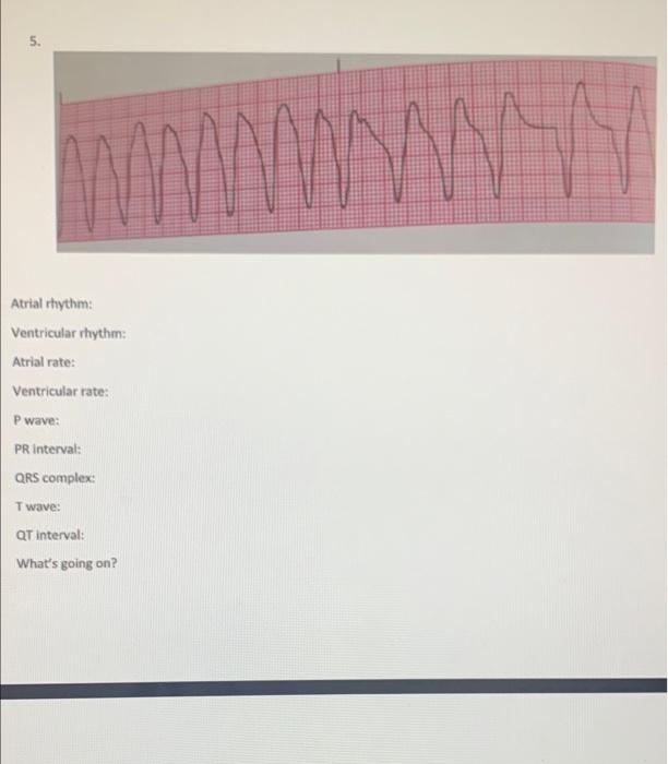 5 Atrial Rhythm Ventricular Rhythm Atrial Rate Ventricular Rate P Wave Pr Interval Qrs Complex Tw Wave Qt Interv 1