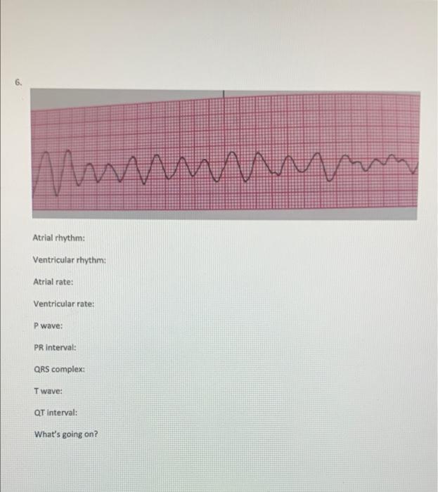 5 Atrial Rhythm Ventricular Rhythm Atrial Rate Ventricular Rate P Wave Pr Interval Qrs Complex Tw Wave Qt Interv 2
