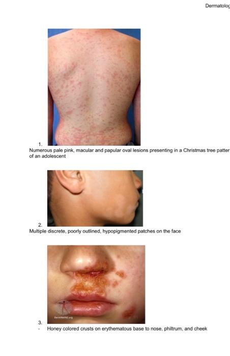 Part I Name That Rash Rash Options A Tinea Capitis B Candidiasis Rash C Scalp Psoriasis D Tinea Versicolor E Pityr 4