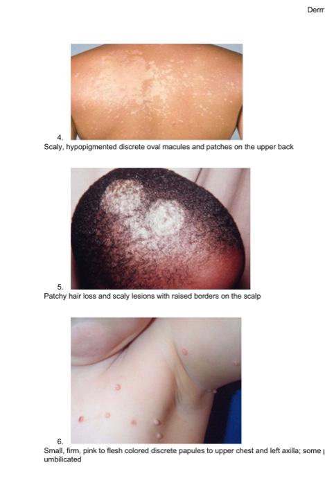 Part I Name That Rash Rash Options A Tinea Capitis B Candidiasis Rash C Scalp Psoriasis D Tinea Versicolor E Pityr 5