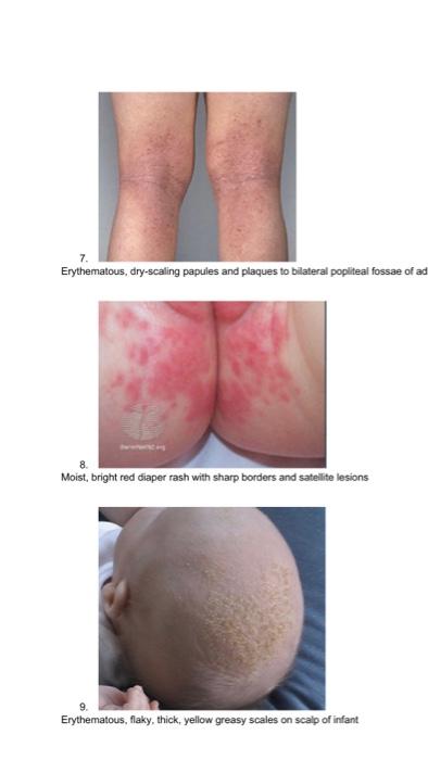 Part I Name That Rash Rash Options A Tinea Capitis B Candidiasis Rash C Scalp Psoriasis D Tinea Versicolor E Pityr 6