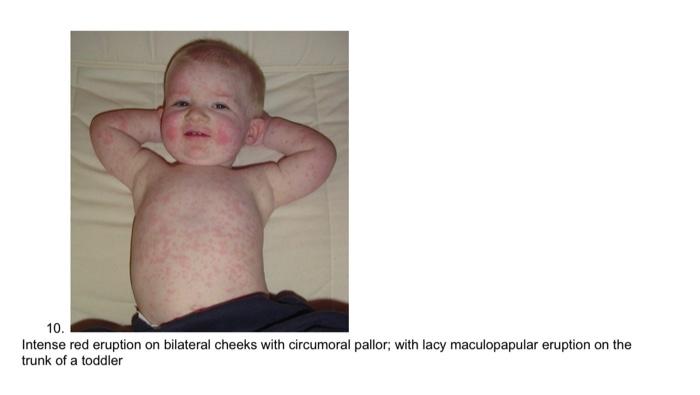 Part I Name That Rash Rash Options A Tinea Capitis B Candidiasis Rash C Scalp Psoriasis D Tinea Versicolor E Pityr 7