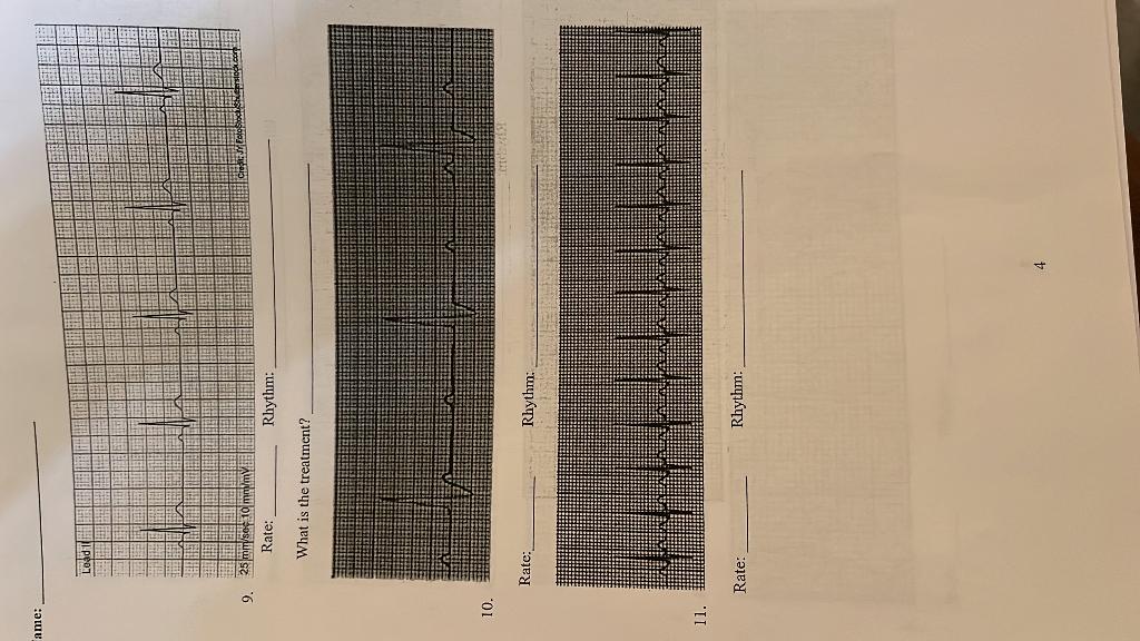 Anie Lead 9 25 Mm Sec 10 Mm My Rate Rhythm What Is The Treatment 10 Rate Rhythm Nnnnnnnnnn 11 Rate Rhythm 4 1