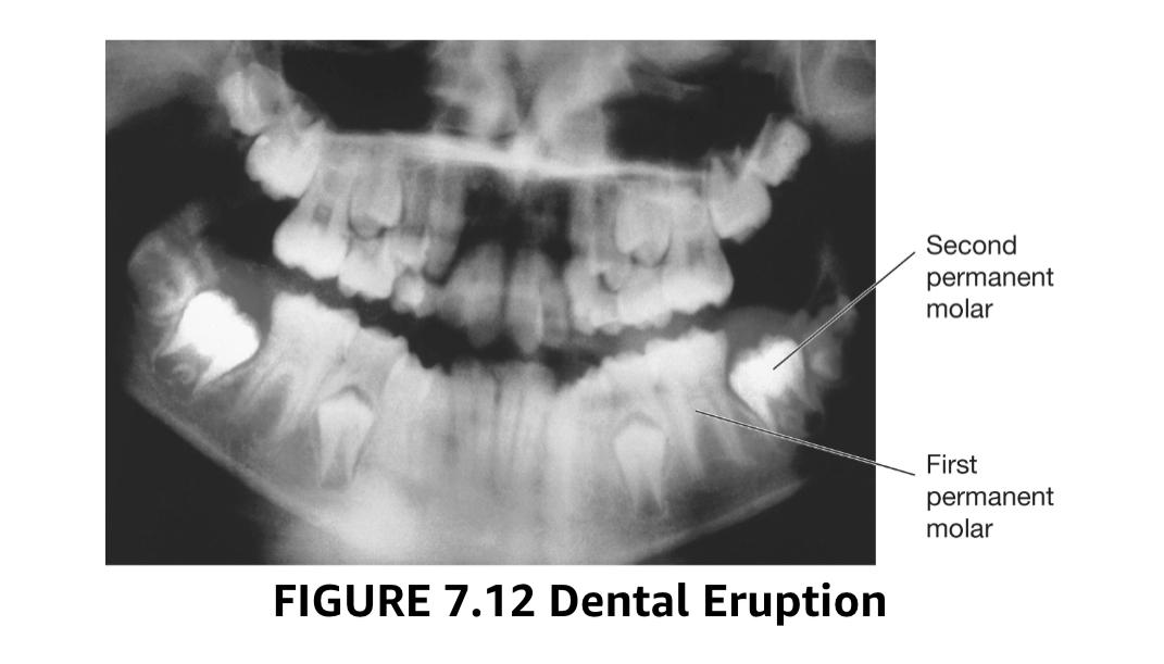Examine The X Ray Of A Juvenile Upper And Lower Jaw From The First Image Provided And Compare It With The Dental Erupt 1