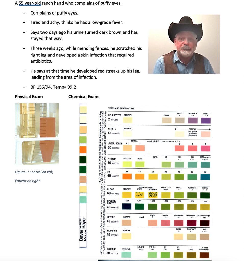 A 55 Year Old Ranch Hand Who Complains Of Puffy Eyes Complains Of Puffy Eyes Tired And Achy Thinks He Has A Low Grade 1