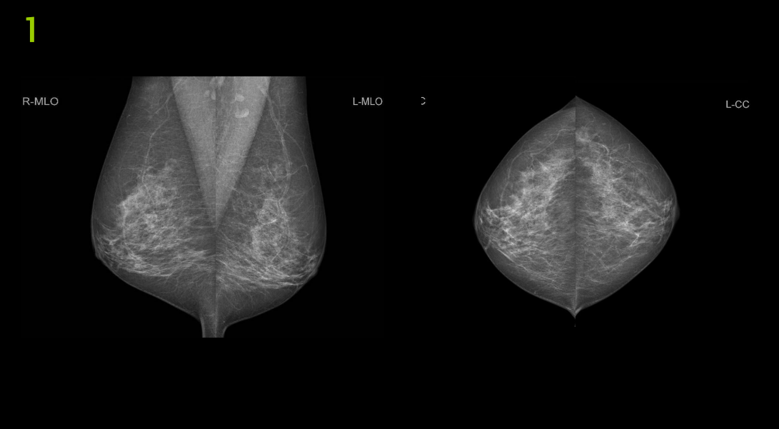 The Image Below Are Mammography Images Please Evaluate Them Using Pgmi Guideline And Answer Them As In The Table Below 1