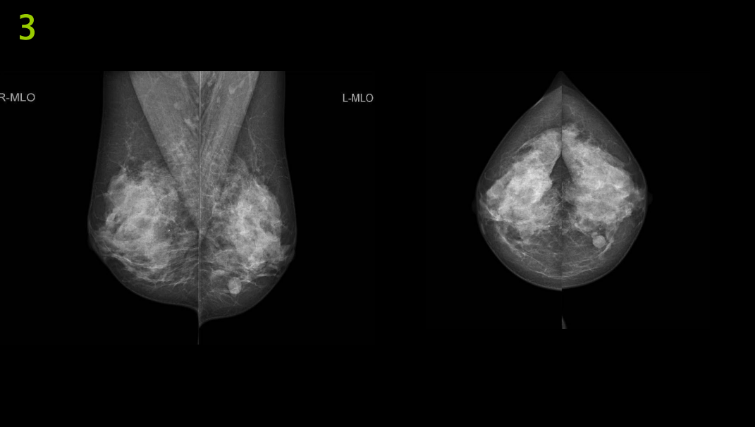 The Image Below Are Mammography Images Please Evaluate Them Using Pgmi Guideline And Answer Them As In The Table Below 2