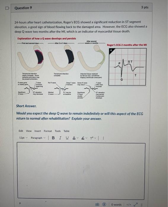 Question 9 24 Hours After Heart Catheterization Roger S Ecg Showed A Significant Reduction In St Segment Elevation A G 1