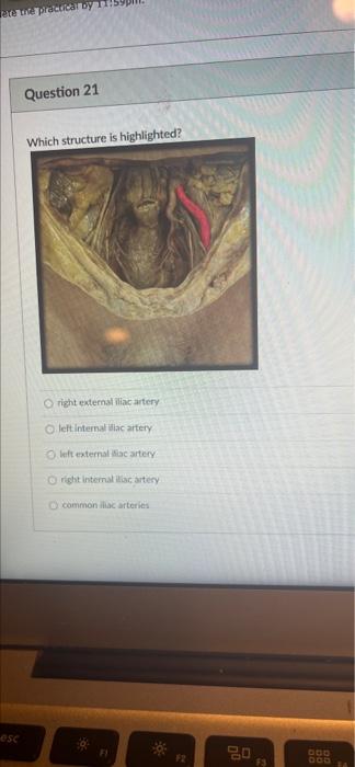 Fate The Practical By Esc Question 21 Which Structure Is Highlighted Oright External Iliac Artery O Left Internal Liac 1