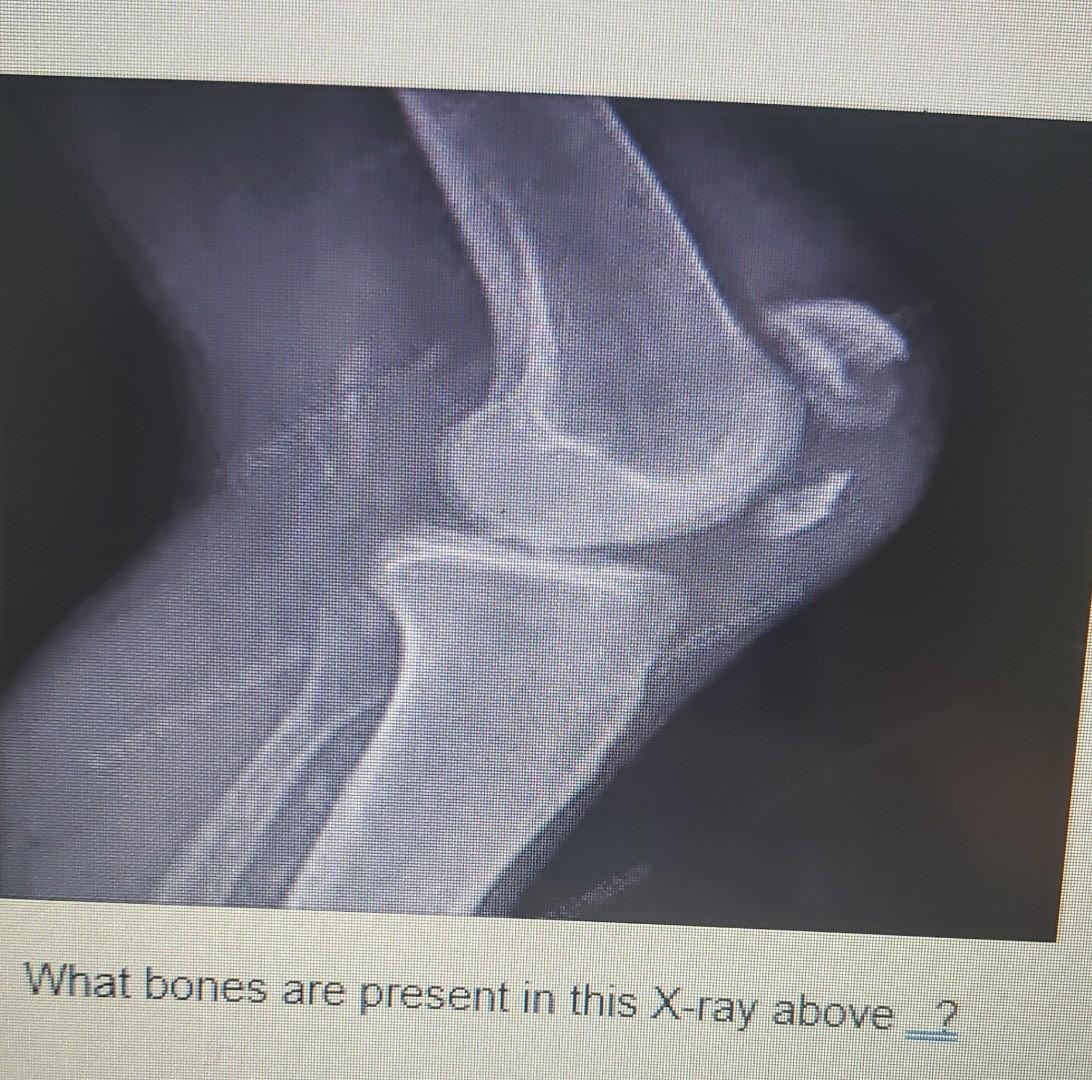 What Bones Are Present In This X Ray Above What Bones Are Present In This X Ray Above What Specific Bone S Are Injur 1