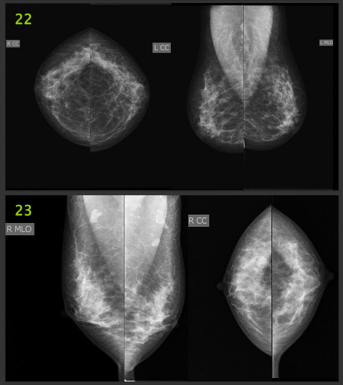 The Image Below Are Mammography Images Please Evaluate Them Using Pgmi Guideline And Answer Them As In The Table Below 2
