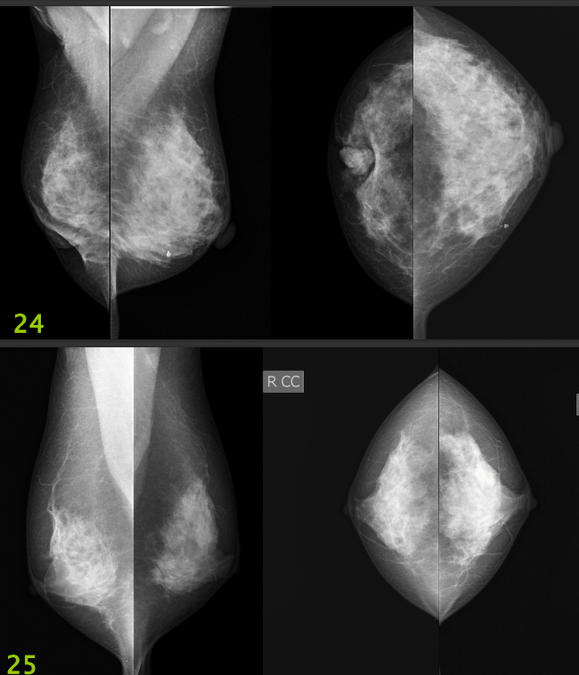 The Image Below Are Mammography Images Please Evaluate Them Using Pgmi Guideline And Answer Them As In The Table Below 3
