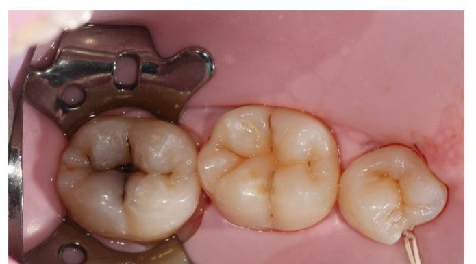 What Icdas Classification Can We Use For These Caries Which Black Classification Dors It Belong And Why 2