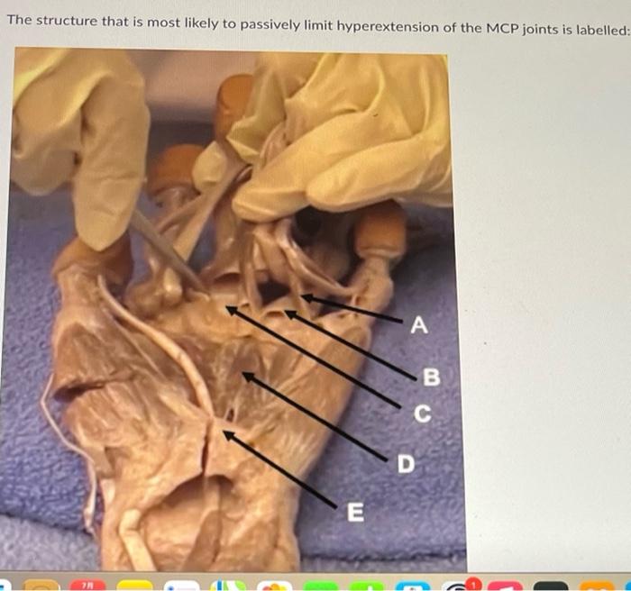 The Structure That Is Most Likely To Passively Limit Hyperextension Of The Mcp Joints Is Labelled E A B C D 1